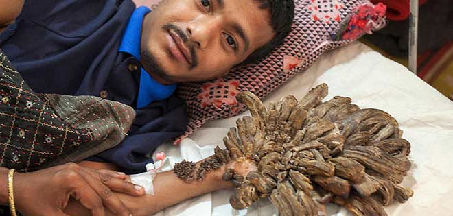El "hombre árbol", dos años atrapado en un hospital de Bangladesh | Diario 2001