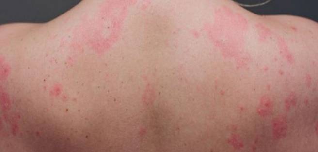 Advierten lesiones en la piel tras contagios por la COVID-19