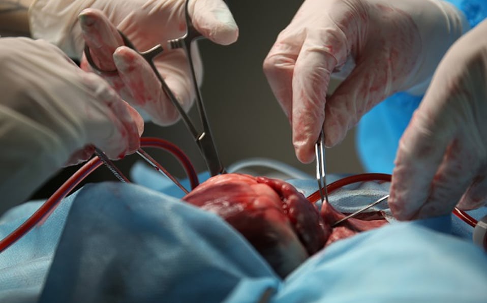 Italia trasplanta dos corazones de donantes COVID-19 con éxito