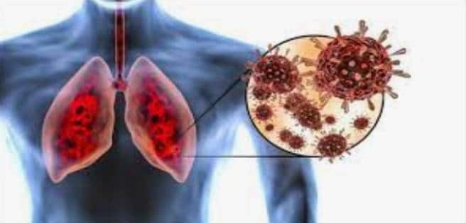 Acumulación de virus en los pulmones: principal causa de muerte por covid