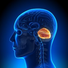 Síndrome Arnold Chiari: malformación congénita del sistema nervioso