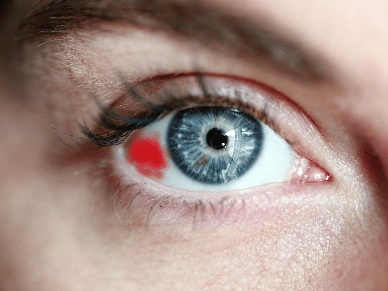 Derrame ocular: causas y consecuencias