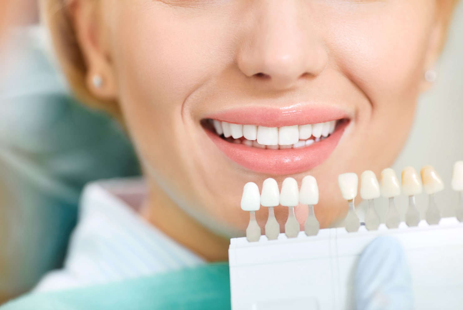 Estética dental recomendada para blanquear los dientes