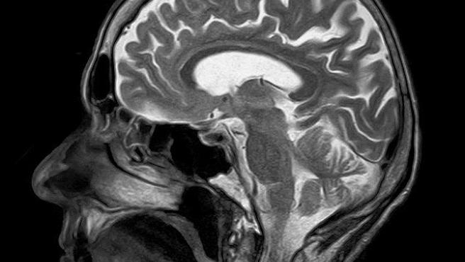 ¿Por qué?: Esta región cerebral es clave en el alzheimer