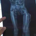 Niña sufrió fractura de una pierna tras brutal golpiza de su madre y padrastro