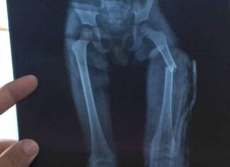 Niña sufrió fractura de una pierna tras brutal golpiza de su madre y padrastro