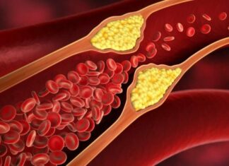 5 síntomas del colesterol alto que no debes ignorar